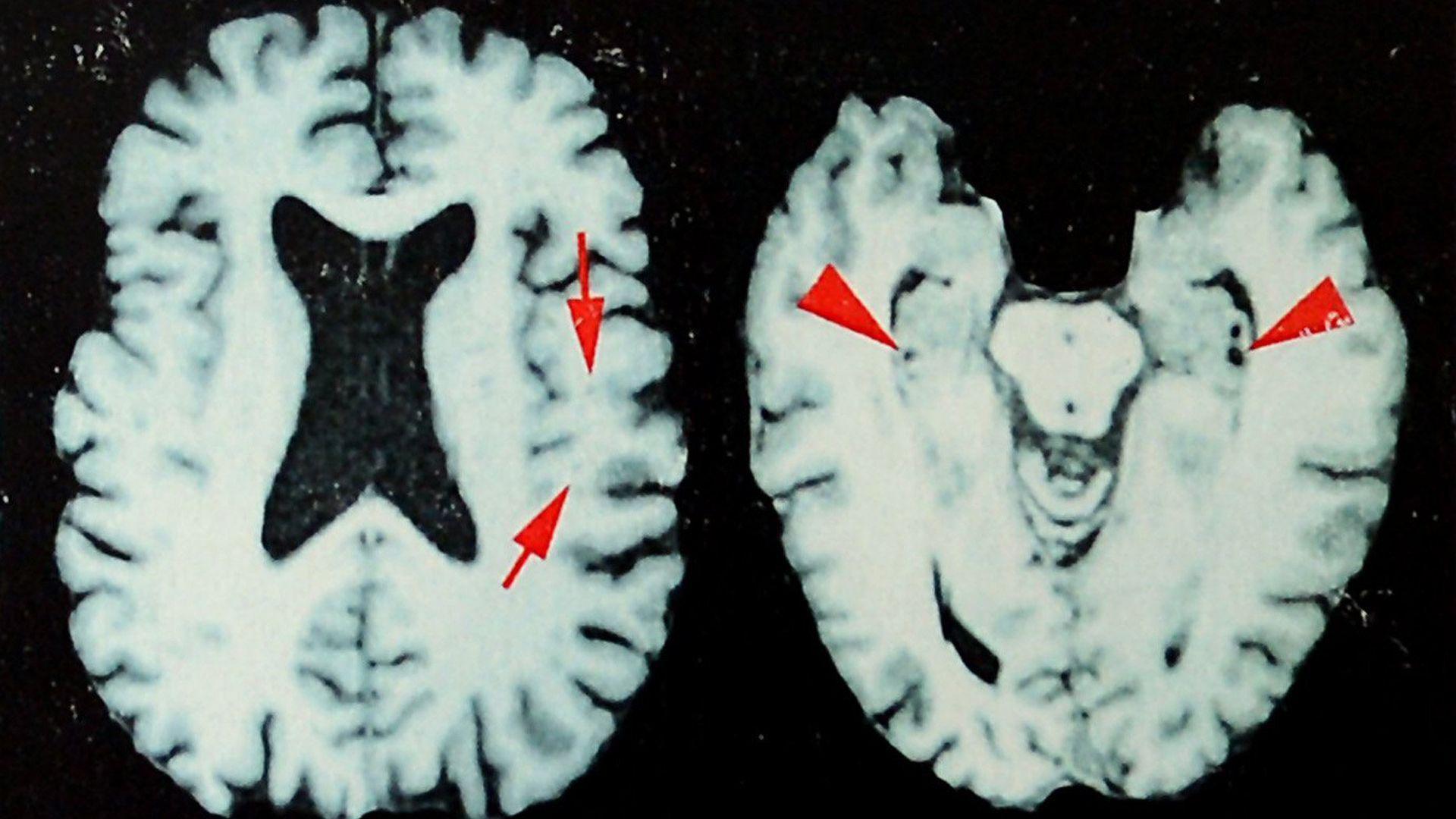 New Study Finds Up to 98% of Deceased NFL Players May Have Suffered Brain Disease from Repeated Head Hits