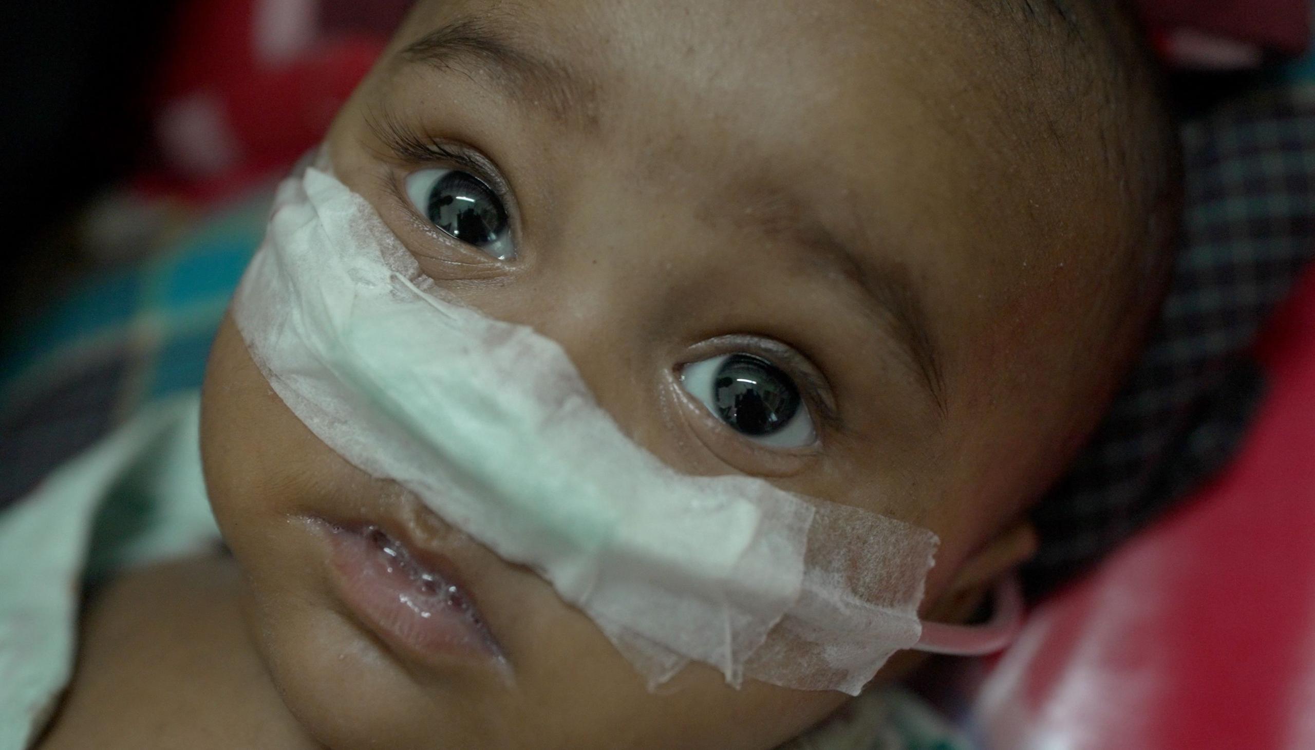 Measles Outbreak Claims Hundreds of Bangladeshi Children as Vaccine Shortages Mount